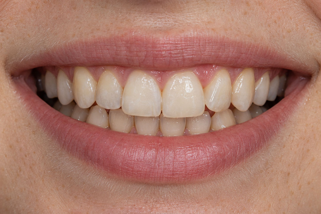 Antes · Alineación dental